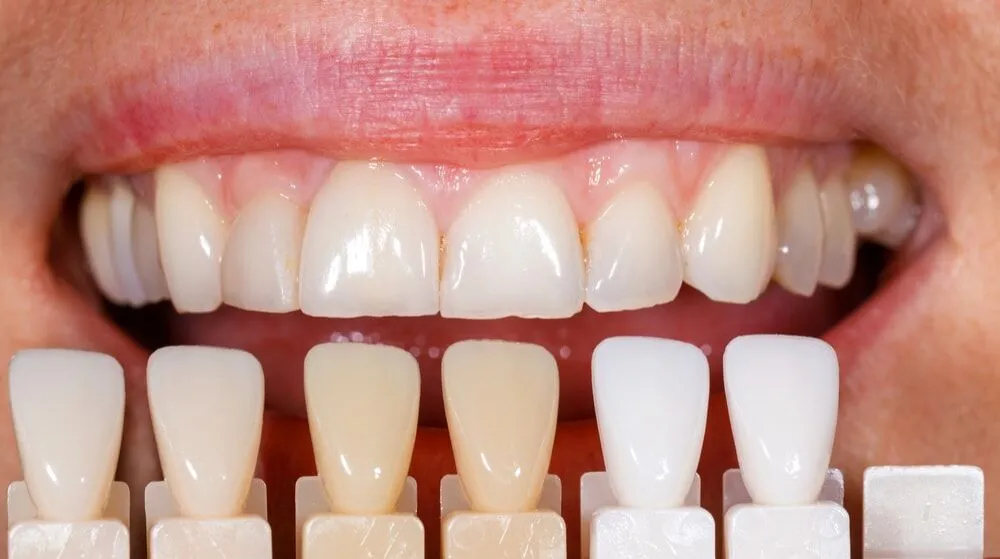 What Happens If You Overdo Laser Whitening Eastbourne