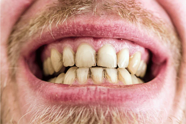 Does Laser Teeth Whitening Work on Coffee, Tea, or Smoking Stains Eastbourne
