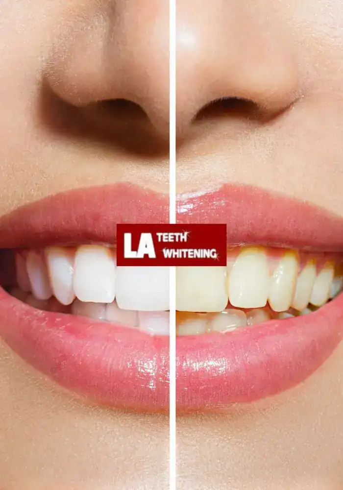 How Safe Is Laser Teeth Whitening for Teenagers and Adults Eastbourne